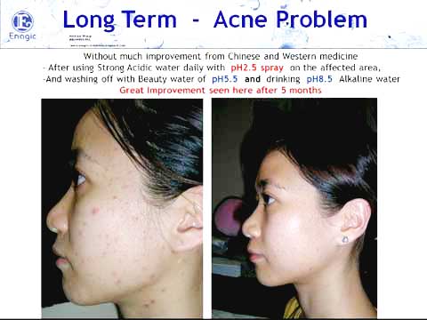 jerawat kangen water beauty water strong acidic water