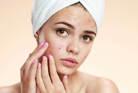 beauty water jerawat