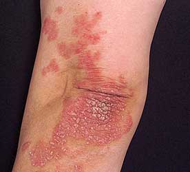psoriasis kangen water